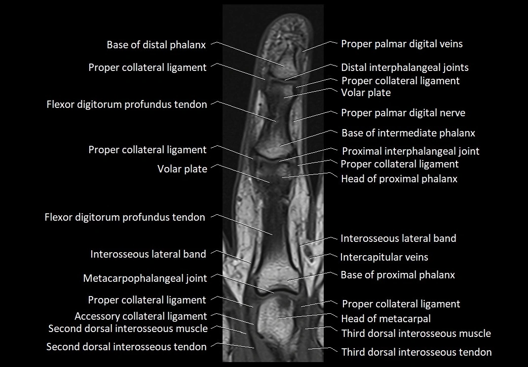 Finger anatomy coronal cross section 3TMRI labelled  image 6.webp